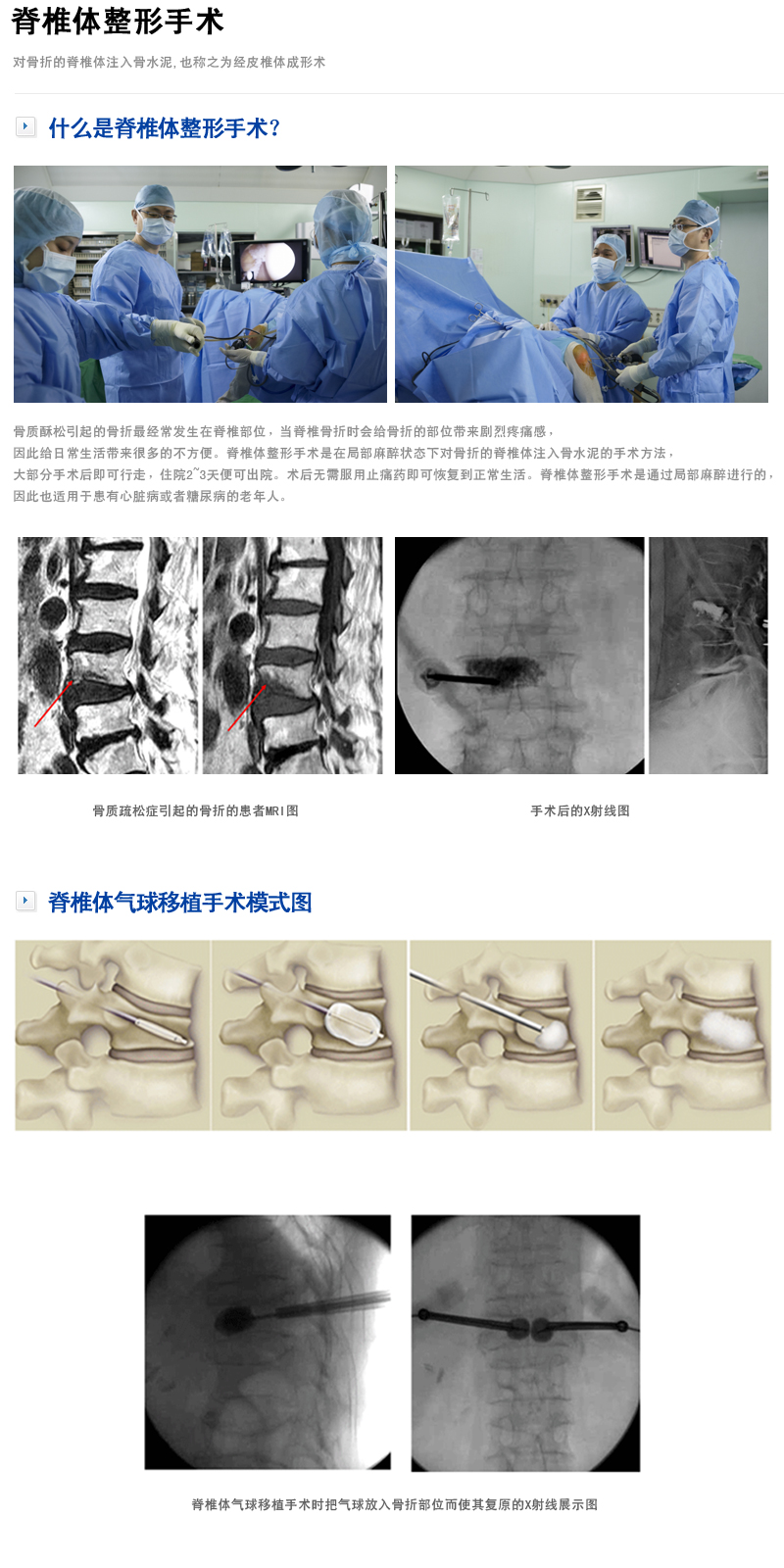 脊椎体整形手术